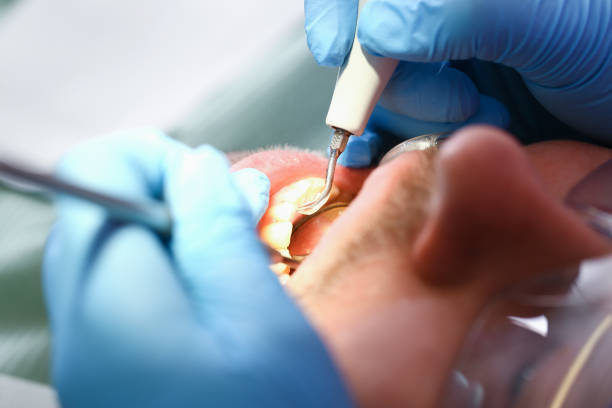 Best Urgent Care for Lost Fillings or Crowns in San Francisco, CA