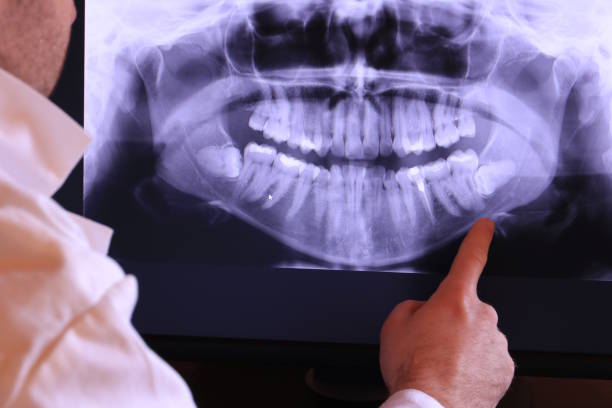 Best Emergency Tooth Extraction in San Francisco, CA
